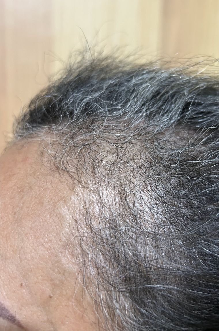 Linha frontal com rarefação e entradas marcadas